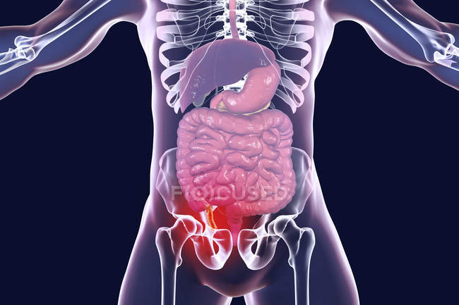 Ilustración digital de la silueta humana con apéndice rojo e inflamado en apendicitis . - foto de stock