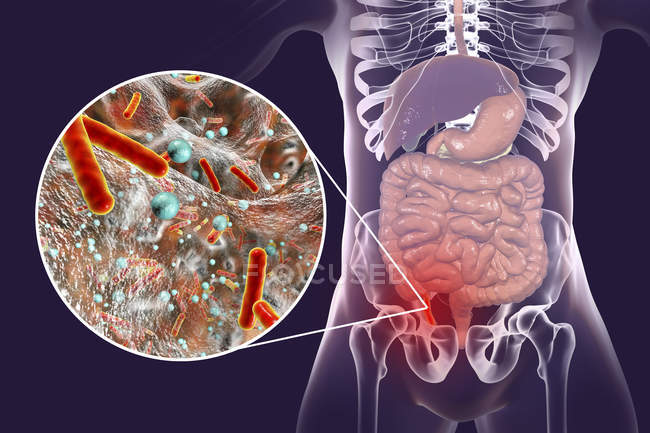 Иллюстрация красного и воспаленного аппендикса человека и крупным планом бактерий возбудителей аппендицита
. — стоковое фото