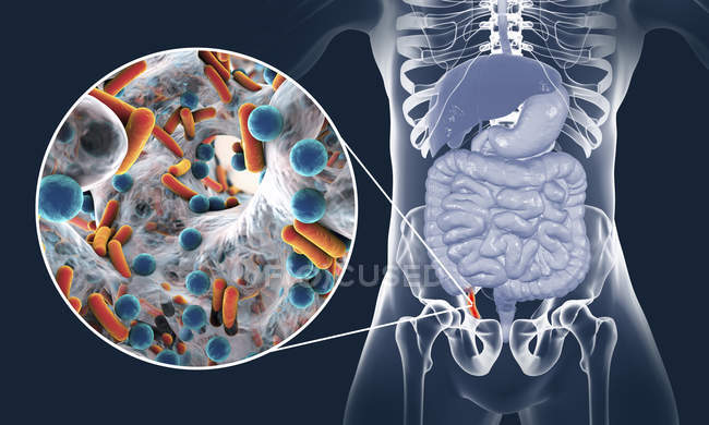Ilustración del apéndice humano rojo e inflamado y primer plano de los agentes causantes de las bacterias de la apendicitis . - foto de stock