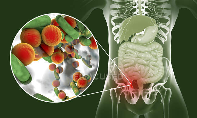 Illustrazione dell'appendice umana rossa e infiammata e primo piano degli agenti causali batterici dell'appendicite . — Foto stock