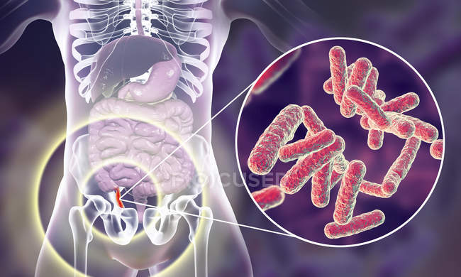 Ilustración del apéndice humano rojo e inflamado y primer plano de los agentes causantes de las bacterias de la apendicitis
. - foto de stock