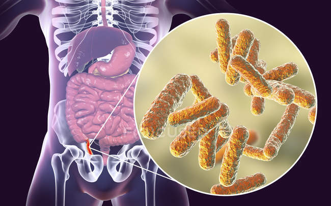 Illustration of red and inflamed human appendix and close-up of bacteria causative agents of appendicitis. — Stock Photo