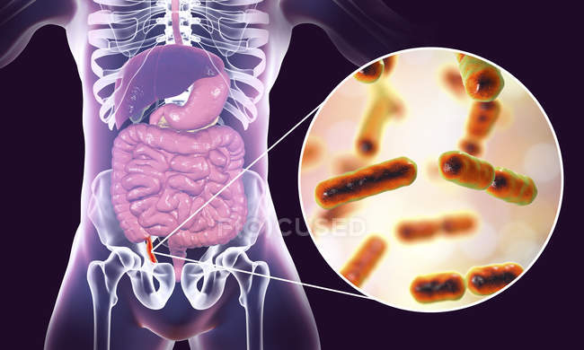 Illustration de l'appendice humain rouge et enflammé et gros plan des agents causals bactériens de l'appendicite . — Photo de stock