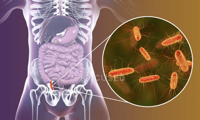 Illustration of red and inflamed human appendix and close-up of bacteria causative agents of appendicitis. — Stock Photo