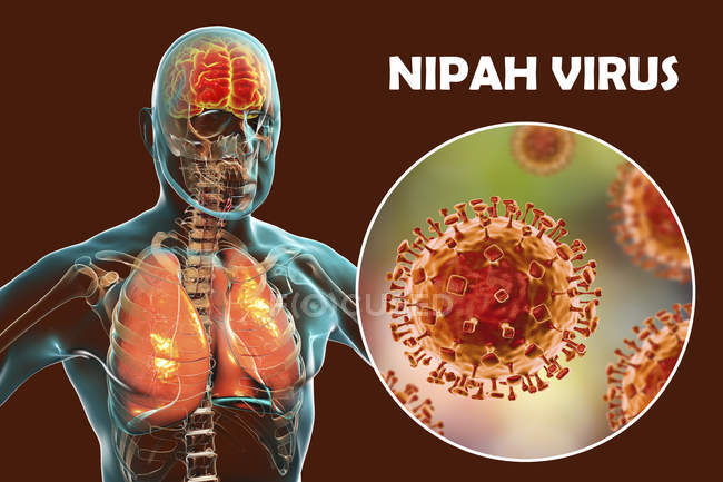 Encephalitis and pneumonia caused by Nipah zoonotic virus, digital illustration. — Stock Photo