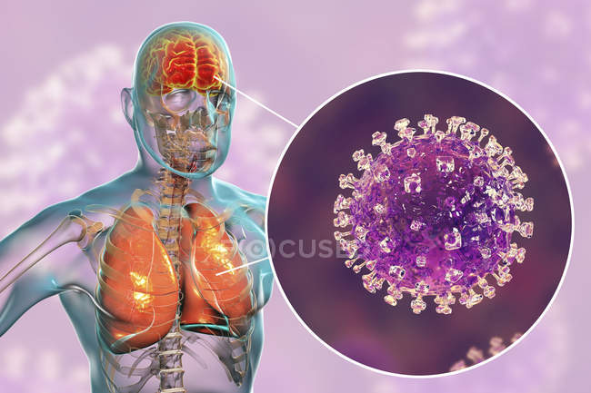 Энцефалит и пневмония, вызванные зоонозным вирусом Нипы, цифровая иллюстрация
. — стоковое фото