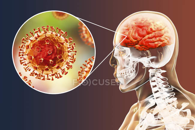 Encefalitis causada por el virus zoonótico de Nipah, ilustración digital . - foto de stock