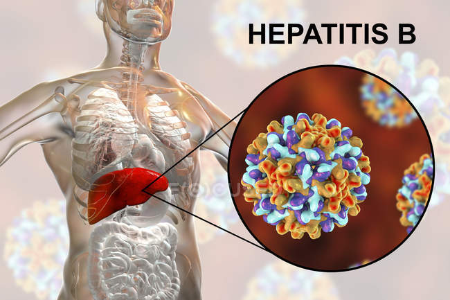 Цифрова ілюстрація силуету з запаленням печінки та крупним планом вірусу гепатиту B . — стокове фото