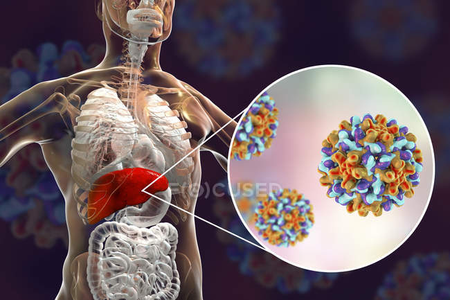 Цифровая иллюстрация силуэта с воспалением печени и крупным планом вируса гепатита В
. — стоковое фото