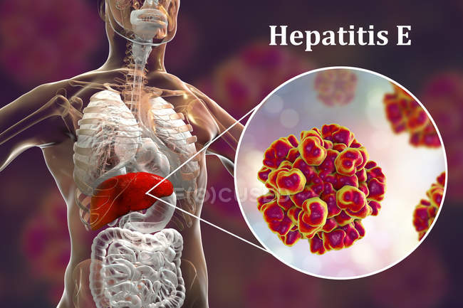 Digital illustration of silhouette with liver inflammation and close-up of hepatitis E virus. — Stock Photo