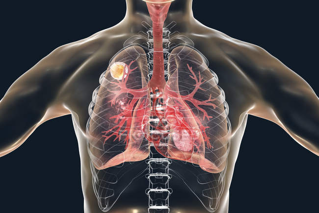 Aspergilloma disease of lungs, digital illustration. — Stock Photo
