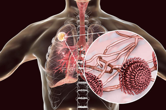 Aspergilloma dei polmoni e primo piano del fungo Aspergillus, illustrazione digitale . — Foto stock