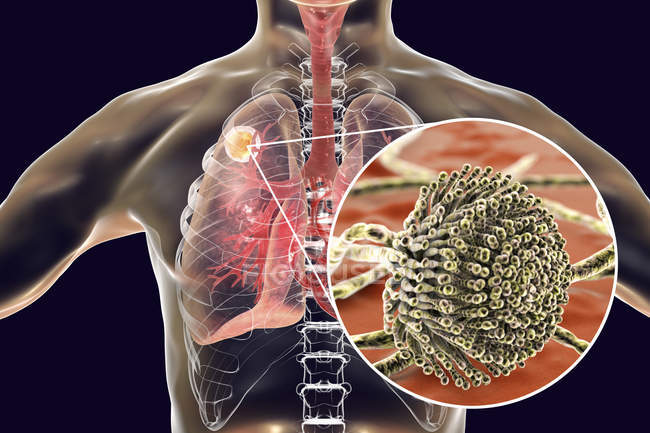 Aspergiloma de los pulmones y primer plano del hongo Aspergillus, ilustración digital
. - foto de stock