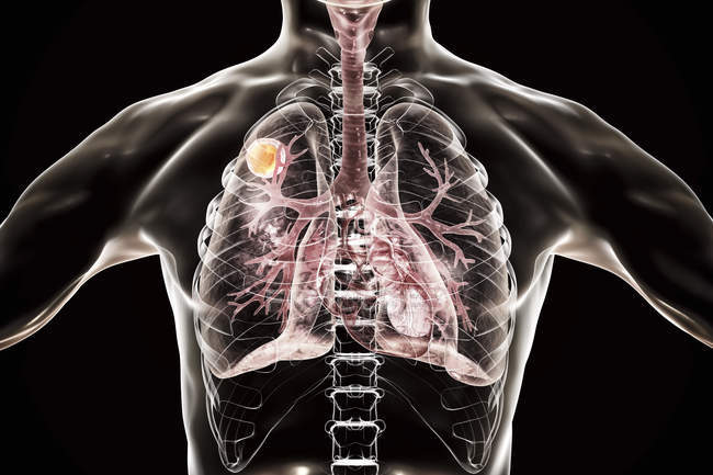 Doença de aspergiloma dos pulmões, ilustração digital . — Fotografia de Stock