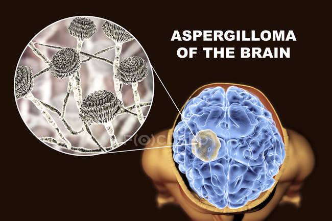 Aspergiloma do cérebro e close-up do fungo Aspergillus, ilustração digital . — Fotografia de Stock