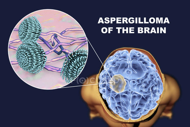 Aspergillom des Gehirns und Nahaufnahme des Aspergillus-Pilzes, digitale Illustration. — Stockfoto