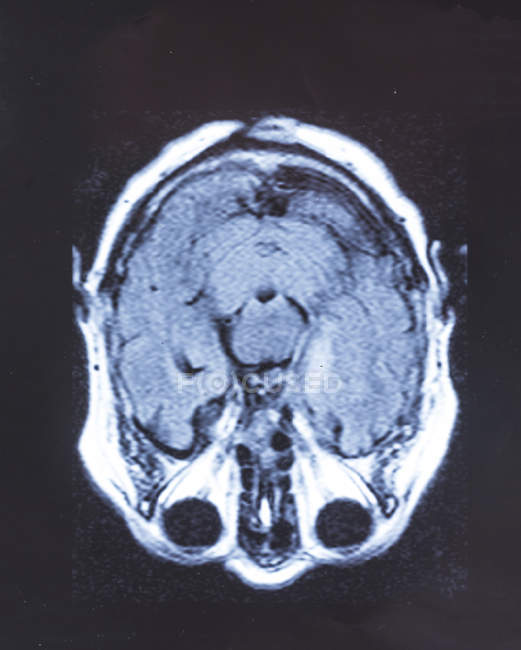 Scansione di risonanza magnetica per immagini del cervello umano . — Foto stock