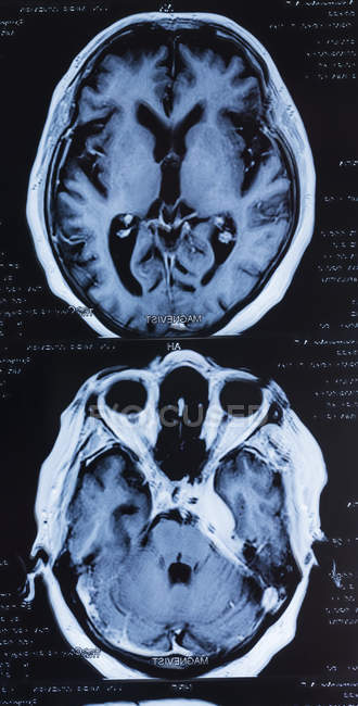 Магнітно-резонансні томографічні сканування мозку людини . — стокове фото