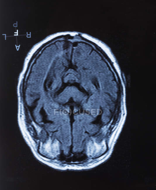Scansione di risonanza magnetica per immagini del cervello umano . — Foto stock
