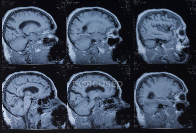 Imagerie par résonance magnétique du cerveau humain . — Photo de stock