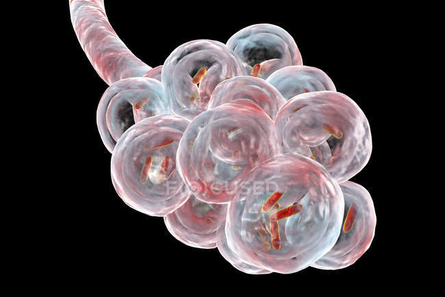 Цифровий ілюстрація того, паличковидні бактерії всередині альвеоли легенів, викликаючи бактеріальної пневмонії. — стокове фото