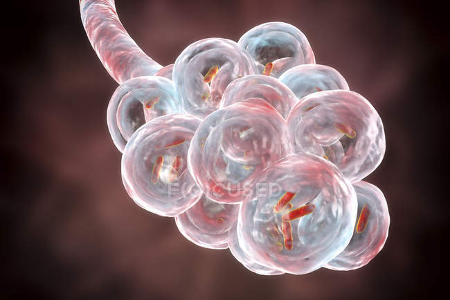 Цифровая иллюстрация палочкообразных бактерий внутри альвеол легких, вызывающих бактериальную пневмонию
. — стоковое фото