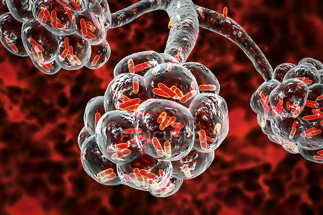 Цифровая иллюстрация палочкообразных бактерий внутри альвеол легких, вызывающих бактериальную пневмонию
. — стоковое фото