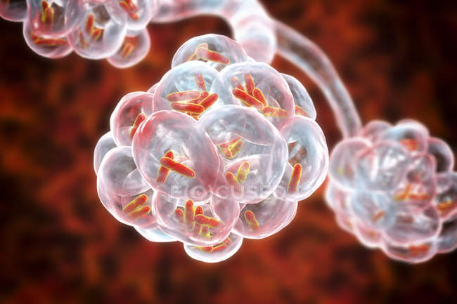 Digitale Illustration von stäbchenförmigen Bakterien in Lungenbläschen, die bakterielle Lungenentzündung verursachen. — Stockfoto