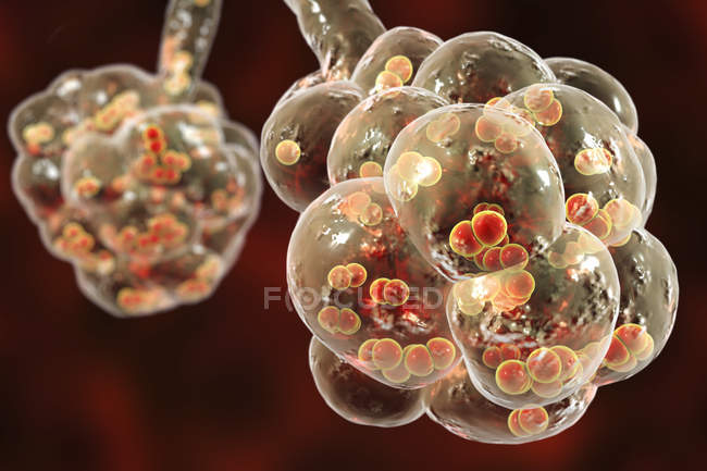 Digital artwork of Streptococcus pneumoniae bacteria inside alveoli of lung causing pneumonia. — Stock Photo