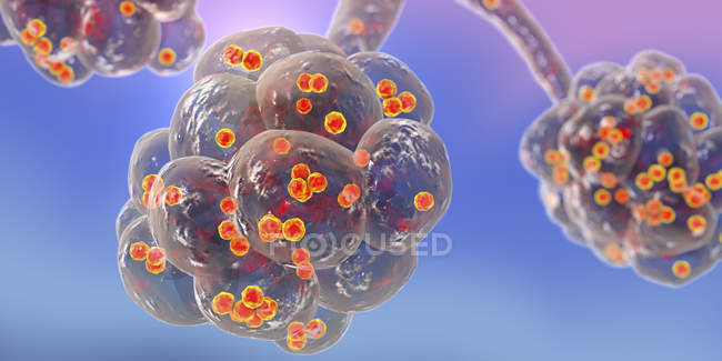 Illustration numérique de la bactérie Staphylococcus aureus dans les alvéoles pulmonaires causant une pneumonie
. — Photo de stock