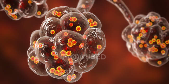 Digital illustration of Staphylococcus aureus bacteria in alveoli of lungs causing pneumonia. — Stock Photo