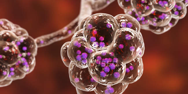 Digitale Illustration von Staphylococcus aureus Bakterien in Lungenbläschen, die Lungenentzündung verursachen. — Stockfoto