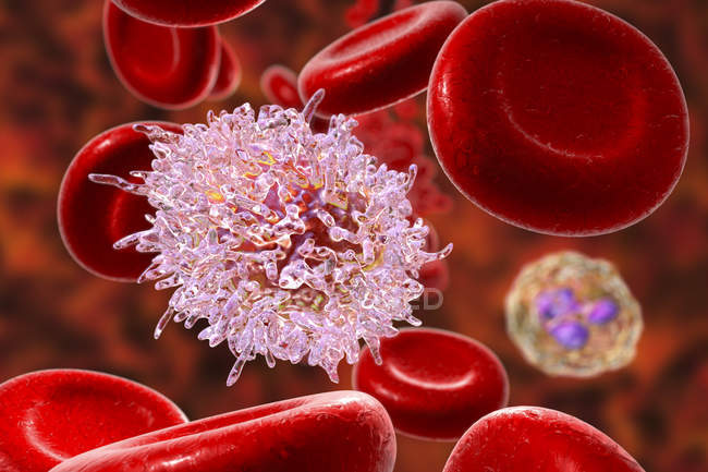 Digital illustration of abnormal blood cells infected by hairy cell leukemia. — Stock Photo