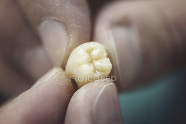 Primo piano di mani maschili con dente artificiale . — Foto stock