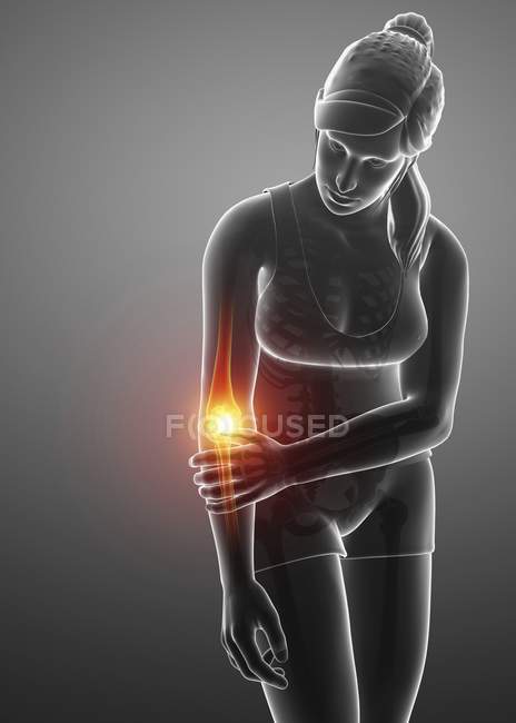 Silhueta feminina com dor no cotovelo, ilustração digital . — Fotografia de Stock
