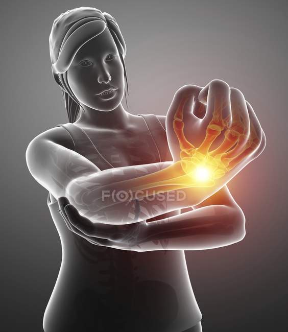 Female silhouette with wrist pain, digital illustration. — Stock Photo