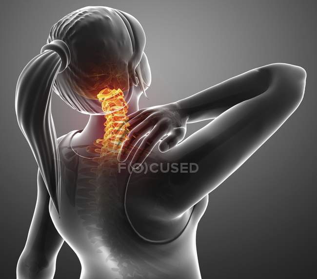 Weibliche Silhouette mit Nackenschmerzen, digitale Illustration. — Stockfoto