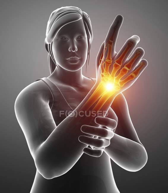 Weibliche Silhouette mit Schmerzen am Handgelenk, digitale Illustration. — Stockfoto