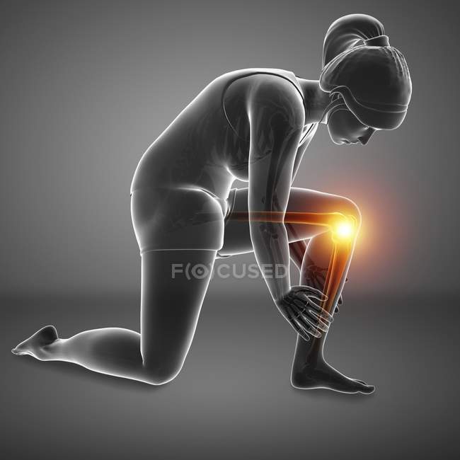 Bending female silhouette with knee pain, digital illustration. — Stock Photo