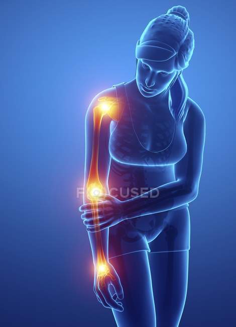 Silueta femenina con dolor en el brazo, ilustración digital . - foto de stock