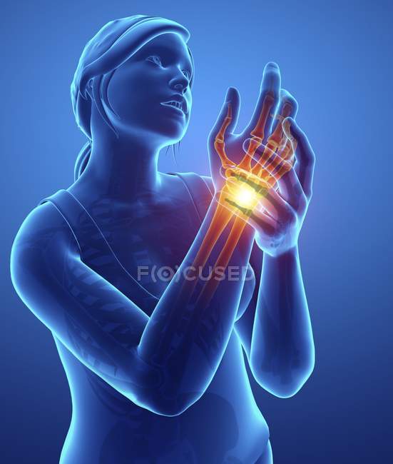Silhouette féminine avec douleur au poignet, illustration numérique . — Photo de stock