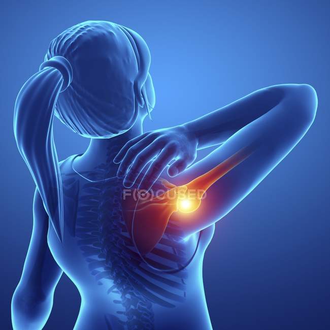 Female silhouette with shoulder pain, digital illustration. — Stock Photo