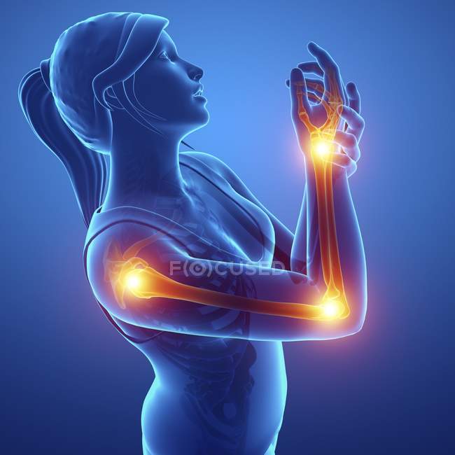 Silhueta feminina com dor no braço, ilustração digital . — Fotografia de Stock