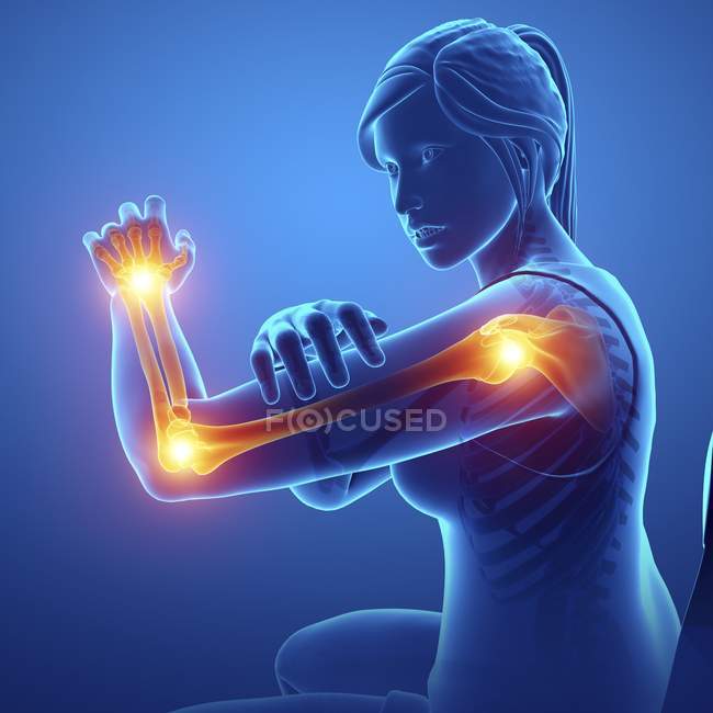 Silhouette féminine avec douleur au bras, illustration numérique
. — Photo de stock