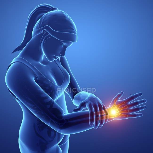 Silhueta feminina com dor de pulso, ilustração digital . — Fotografia de Stock