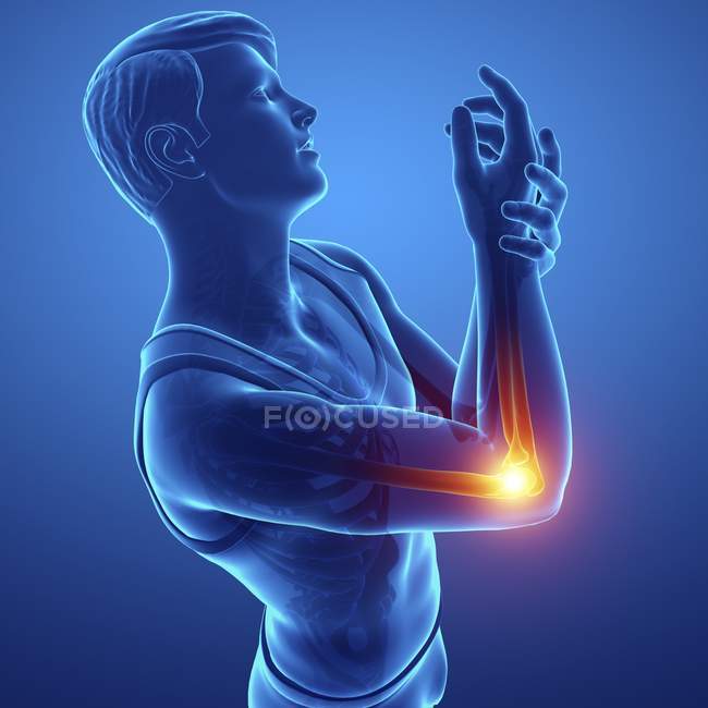 Silhueta masculina com dor no cotovelo, ilustração digital . — Fotografia de Stock