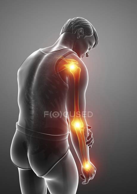 Male silhouette  with arm pain, digital illustration. — Stock Photo