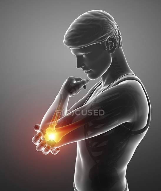 Silhouette maschile con dolore al gomito, illustrazione digitale . — Foto stock