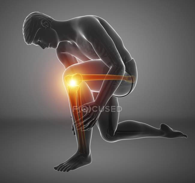 Bending male silhouette with knee pain, digital illustration. — Stock Photo