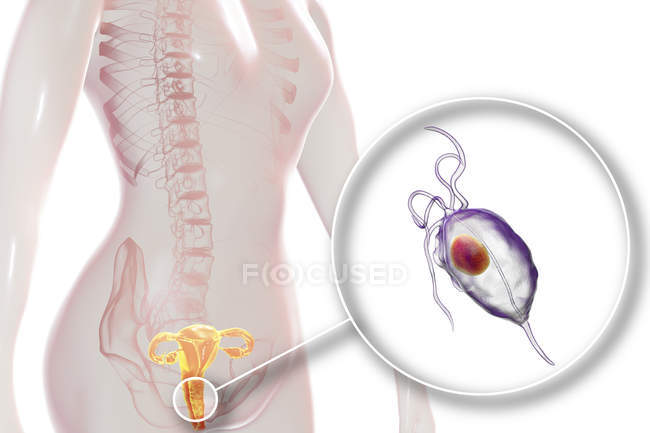 Иллюстрация женской репродуктивной системы и влагалища трихомонада, вызывающего трихомониаз . — стоковое фото